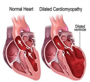 扩张型心肌病2