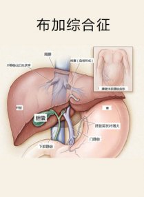 布加氏综合征