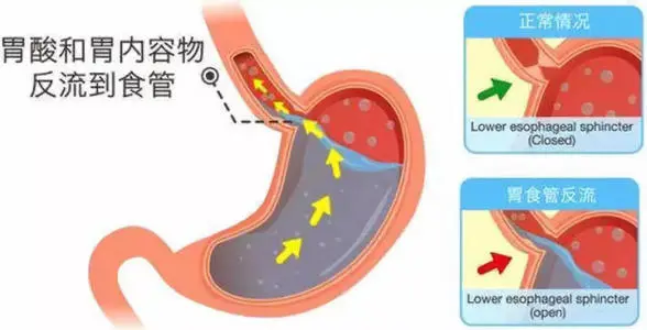 反流性食管炎