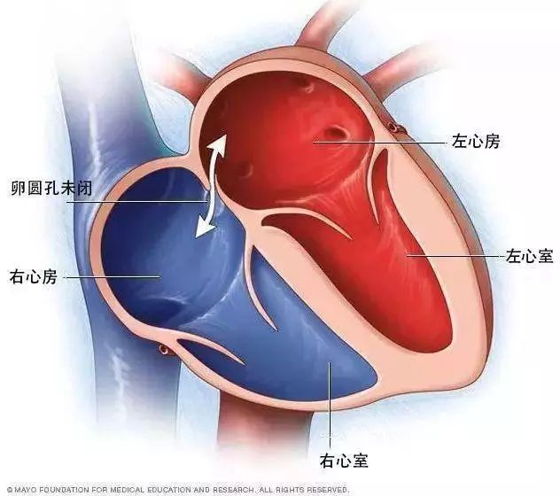 卵圆孔未闭-先天性心脏病