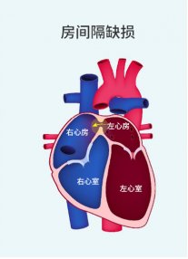 房间隔缺损-封堵