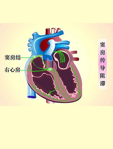 房室传导阻滞