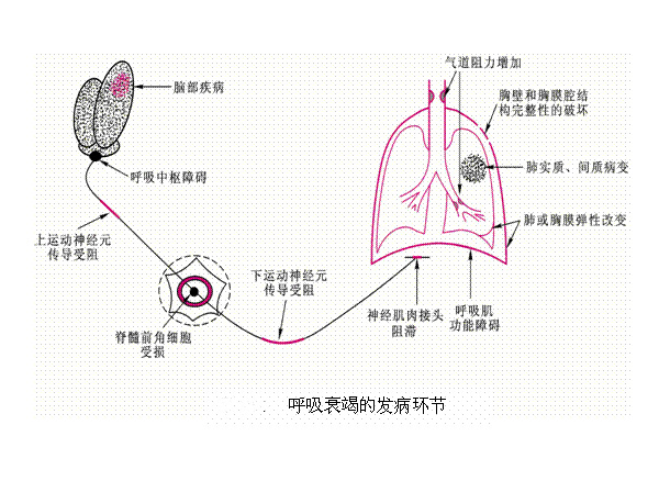 呼吸衰竭