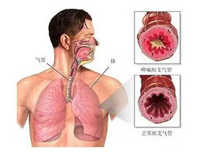 支气管哮喘