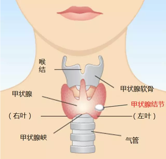 甲状腺结节