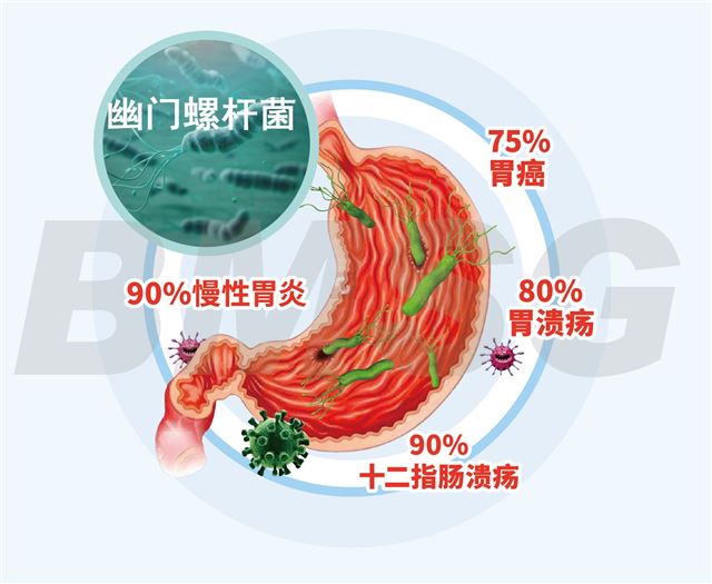 萎缩性胃炎